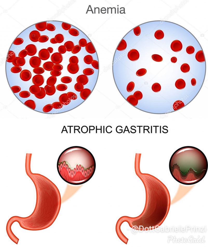 Gastrite Atrofica, Ferro basso, Anemia Perniciosa, e Gastroprotettore