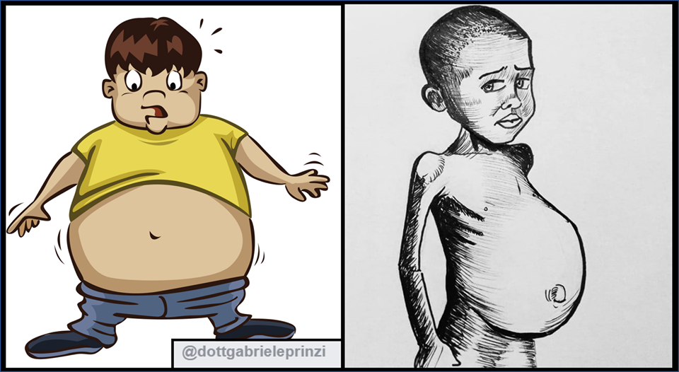 Obesità: causata da iperalimentazione o da malnutrizione? Il caso del Kwashiorkor
